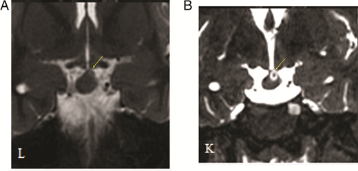 Hypothalamic hamartoma. Twenty-one-year-old woman with gelastic seizures and hypothalamic obesity. After HIFU, she became seizure-free and her weight stabilized. A, Coronal T2 image demonstrates remnant of previously resected hamartoma (yellow arrow) along left side of third ventricle. B, Post-HIFU treatment coronal T2 image with new hyperintensity at targeted location (yellow arrow). Courtesy of John Ragheb, MD.