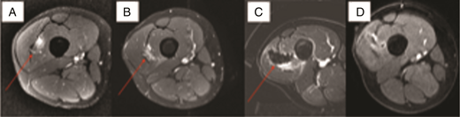 Vascular malformation. An 18-year-old boy with pain in lateral right thigh. A, Axial MRI with enhancing vascular malformation before surgery (red arrow). B, Axial MRI 3 months postsurgical excision with recurrence (red arrow). C, Immediate post-HIFU MRI with nonperfusion and ablation of the nidus on postcontrast MRI (red arrow). D, Three-month post-HIFU axial MRI with no residual malformation or pain. Courtesy of Pejman Ghanouni, MD, PhD.