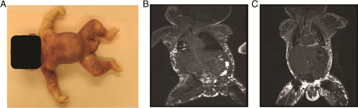 A, Postmortem image showing diffuse subcutaneous edema. B, MRI lymphangiogram showing diffuse ectasia of multiple subcutaneous lymphatic channels over the upper thighs, pelvis, and trunk level of the axilla. Absence of any visible central lymphatic ducts or structure suggests congenital absence or atresia of the central collecting lymphatics. C, Follow-up MRI lymphangiogram 40 days after the previous study, showing increased distension of the subcutaneous, paraspinal, perirectal, and inguinal regions caused by lymphangiectasia. The previously demonstrated lymphatic flow to the bowel wall and lumen was no longer seen.