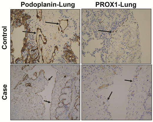 IHC of the lung of our proband compared with a 5-month-old matched control patient. Podoplanin in control and case specimens of lung revealed linear endothelial staining of lymphatics, confirming that lymphatic vascular development was normal. Absence of PROX1 staining (a key lymphatic endothelial marker required for lymphatic valve development) in the proband lung showed lack of lymphatic valve development, leading to nonimmune hydrops. Arrows point to ECs.