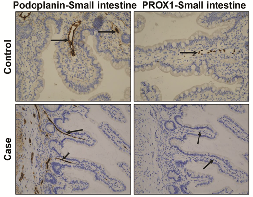 IHC of intestine of our proband compared with a 5-month-old matched control patient. Podoplanin in control and case specimens of intestine revealed linear endothelial staining, confirming that lymphatic vascular development was normal. Absence of PROX1 staining in intestinal specimens of the proband showed lack of lymphatic valve development, leading to nonimmune hydrops. Arrows point to ECs.