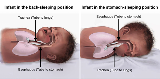 Back sleeping does not increase the risk of choking. In fact, infants may be better able to clear fluids when they are on their backs, possibly because of anatomy. When an infant is in the back-sleeping position, the trachea lies on top of the esophagus. Anything regurgitated or refluxed from the esophagus must work against gravity to be aspirated into the trachea. When an infant is in the stomach-sleeping position, anything regurgitated or refluxed will pool at the opening of the trachea, making it easier for the infant to aspirate or choke. Image and caption courtesy of the Safe to Sleep campaign, for educational purposes only; Eunice Kennedy Shriver National Institute of Child Health and Human Development, http://www.nichd.nih.gov/sids. Safe to Sleep is a registered trademark of the United States Department of Health and Human Services.