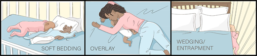 Depictions of common mechanisms for accidental sleep-related infant suffocation. Airway obstruction from soft objects or loose bedding is the most common mechanism of accidental infant suffocation. Wedging or entrapment between 2 inanimate objects can result in compression or obstruction of the nose and mouth or thorax. Overlay occurs when a person is found to be on top of or against the infant, obstructing the infant’s airway. Image courtesy of the CDC.