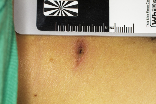 A 14-Year-Old Boy With Neck Pain, Fevers, and Diffuse Erythematous Rash ...