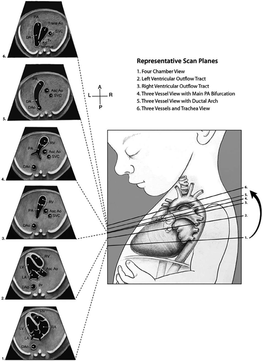 Representative scan planes for fetal echocardiography include an evaluation of the 4-chamber view (1), left and right arterial outflow tracts (2 and 3, respectively), two variants of the 3-vessel view, one demonstrating the main pulmonary artery bifurcation (4) with another more superior plane that demonstrates the ductal arch (5), and the 3-vessel and trachea view (6). Not all views may be seen from a single cephalic transducer sweep without some minor adjustments in the position and orientation of the transducer due to anatomic variations and the fetal lie. Asc Ao, ascending aorta; DAo, descending aorta; LA, left atrium; LV, left ventricle; PA, pulmonary artery; RA, right atrium; RV, right ventricle; and Tr, trachea. AIUM Practice Parameter for the Performance of Fetal Echocardiography.16 © 2020; reproduced with permission.