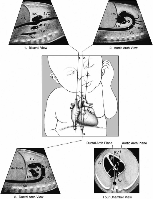 Sagittal views of the superior and inferior venae cavae (1), aortic arch (2), and ductal arch (3). The scan angle between the ductal arch and thoracic aorta ranges between 10 and 19 during pregnancy, as illustrated by the 4-chamber view diagram (lower right). Ao, descending aorta; Ao Root, aortic root; DA, ductus arteriosus; IVC, inferior vena cava; LA, left atrium; LV, left ventricle; PV, pulmonary valve; RA, right atrium; RPA, right pulmonary artery; RV, right ventricle; and SVC, superior vena cava. AIUM Practice Parameter for the Performance of Fetal Echocardiography.16 © 2020; reproduced with permission.