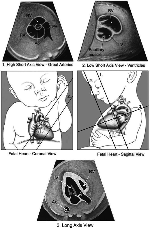 High short-axis view (1), low short-axis view (2), and long-axis view (3) of the fetal heart. Ao, aortic valve; LV, left ventricle; PA, pulmonary artery; RA, right atrium; and RV, right ventricle. AIUM Practice Parameter for the Performance of Fetal Echocardiography.16 © 2020; reproduced with permission.