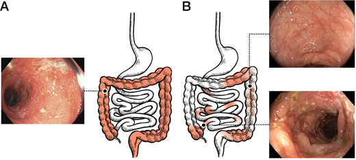 Patchy Inflammation Pediatric Inflammatory Bowel Disease | Pediatrics | American Academy of ...