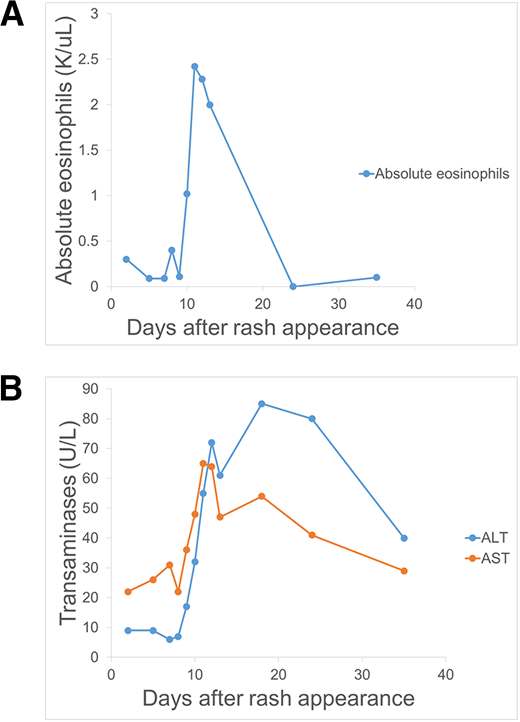 The trend of absolute eosinophils and transaminases. Absolute eosinophils were normal until rash day 10 and transaminases were normal until rash day 9 before rising. Clinicians should be aware of the variable laboratory abnormality timeline in DRESS. Abnormalities can be delayed for 1 to 3 weeks from symptom onset.