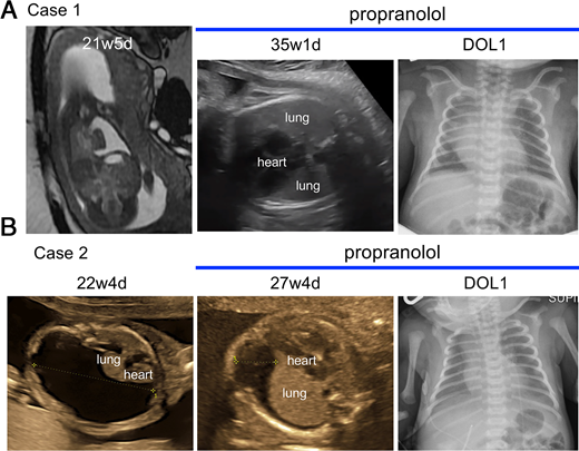 Propranolol use associated with pleural effusion resolution in prenatal CC cases.
