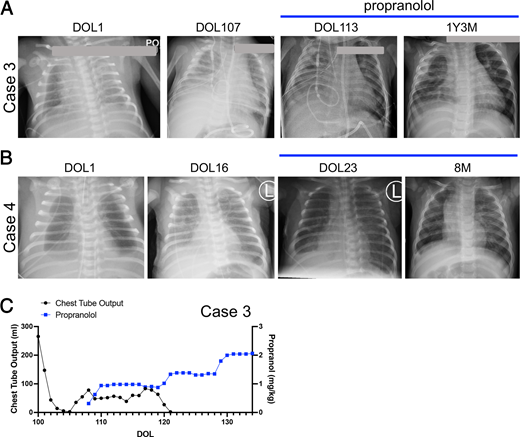 Propranolol use associated with pleural effusion resolution in postnatal CCs.