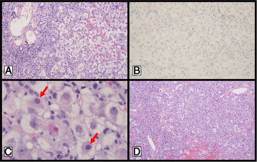 (A) Percutaneous liver biopsy at 200× demonstrating severe, diffuse mixed portal, and lobular inflammation with associated hepatocellular ballooning, cholestasis, and piecemeal necrosis. (B) Negative immunohistochemical stain for adenovirus. (C) Reactive nuclear changes suggestive of viral cytopathic effect (arrow). (D) Explant histology at 100× demonstrating fulminant hepatitis with disrupted lobular architecture resulting from extensive portal expansion and diminished residual lobular hepatocytes; marked, primarily lobular, lymphoplasmacytic infiltrate; severe reactive hepatocellular changes with giant cell formation, ballooning degeneration, and cholestasis.