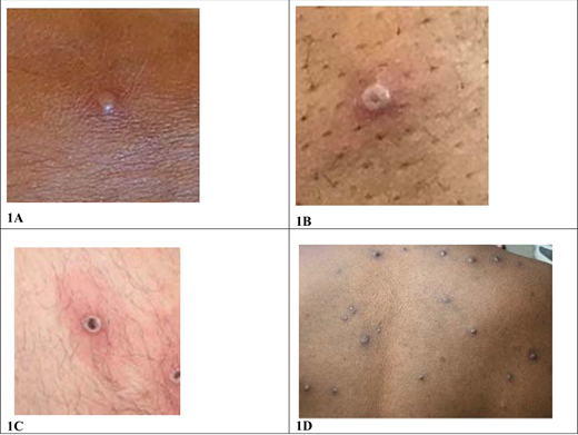 Mpox in Children and Adolescents: Epidemiology, Clinical Features ...