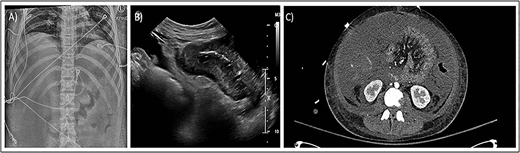 Severe Clostridioides difficile infection in children. (A) Abdominal radiograph showing thickened colon most prominent in the transverse colon. (B) Abdominal sonogram showing hypoechoic diffuse large bowel wall thickening. (C) CT Abdomen and pelvis showing markedly thickened colon wall in an adolescent with fulminant C. difficile colitis.