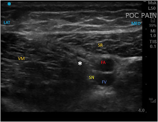 Ultrasound image using a linear array transducer demonstrating the anatomy of the saphenous nerve and final stimulating electrode position. FA, femoral artery; FV, femoral vein; LAT, lateral; MED, medial; SN, saphenous nerve; SR, sartorius muscle; VM, vastus medialis. *Final position of the stimulating electrode.