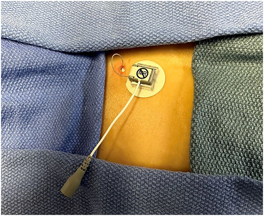 Image demonstrating the implanted lead at the skin after being trimmed and secured.