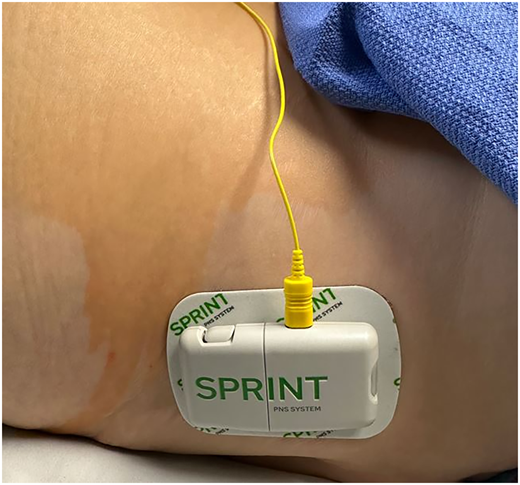 Image demonstrating the pulse generator mounted on the body (side of the hip) using an adhesive hydrogel pad.