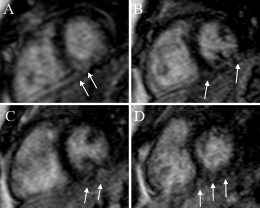A-D: Short-axis stack demonstrating patchy areas of LGE in the subepicardium and mid myocardium of the LV inferior wall and septum. Arrows indicate areas of LGE.