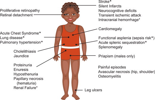 Complications of SCD. Additional complications: Anemia, delayed growth, and sexual maturation. * Potential cause of mortality.