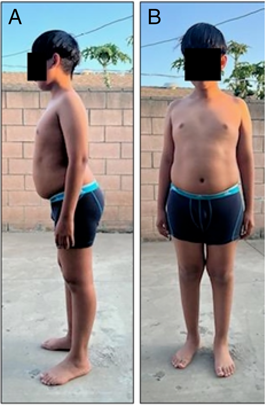 A Reversible Etiology of Progressive Motor Decline in a Previously ...