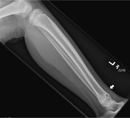 Chronic Recurrent Multifocal Osteomyelitis Involving the Spine, Sternum ...