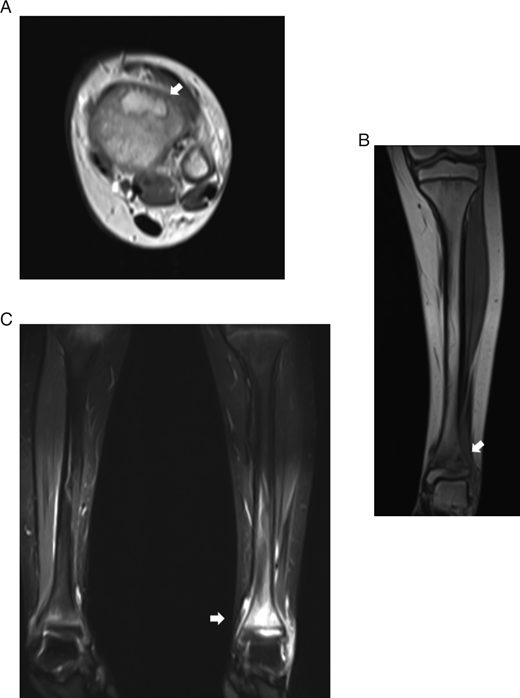 Chronic Recurrent Multifocal Osteomyelitis Involving the Spine, Sternum ...