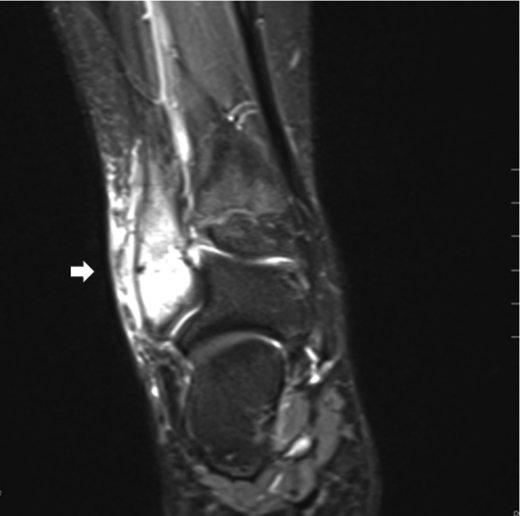 Chronic Recurrent Multifocal Osteomyelitis Involving the Spine, Sternum ...