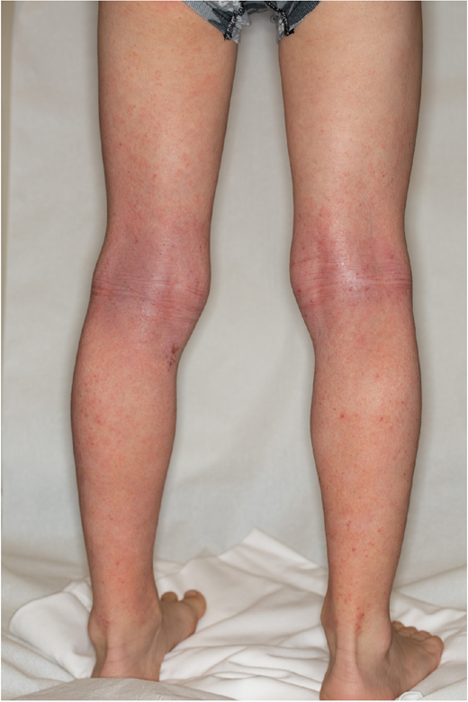 Poorly-defined erythema in the popliteal fossae, a typical distribution for pediatric atopic dermatitis.