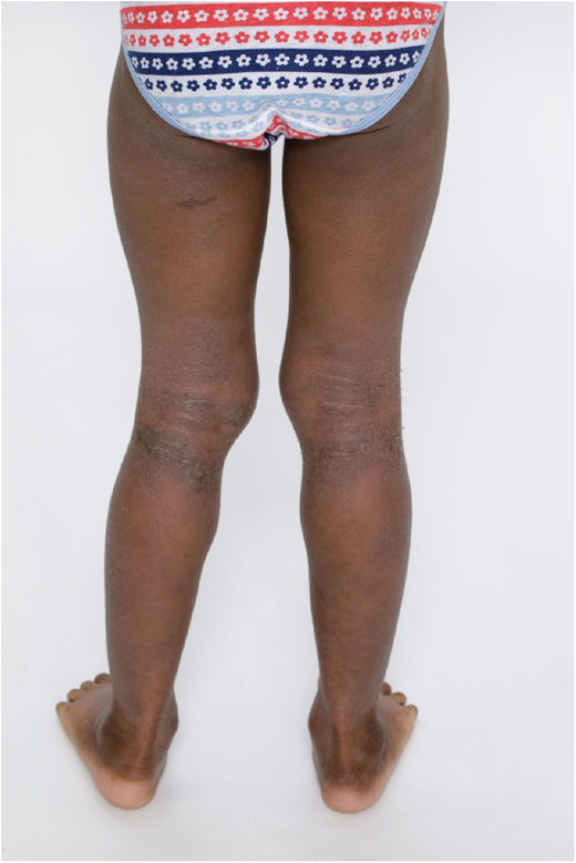 Erythema in the popliteal fossae and posterior legs is deeper red and less prominent in darker skin compared to lighter skin; lichenification and dyspigmentation are apparent.