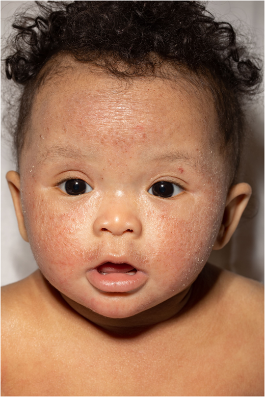 Prominent cheek involvement is typical of infantile atopic dermatitis.