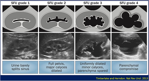 Society for Fetal Urology Grading System.