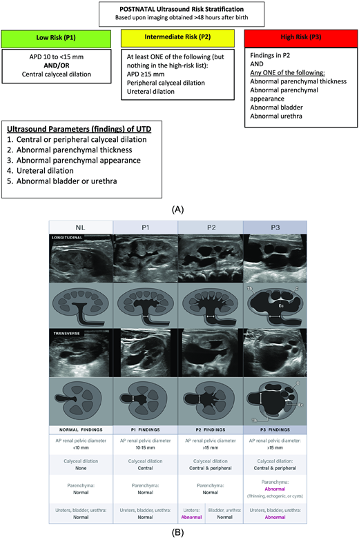 (A) Postnatal ultrasound risk stratification. Stratification is based upon the most concerning ultrasound finding. For example, if the anterior-posterior renal pelvis diameter (APD) is in the UTD P1 range, but there is peripheral calyceal dilation, the classification is UTD P2. Similarly, the presence of parenchymal abnormalities denotes UTD P3 classification, regardless of APD measurement. (B) Postnatal Urinary Tract Dilation Grading System.