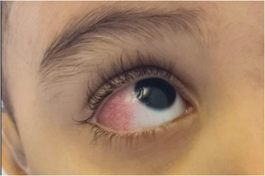 Unexpected Death in a Young Child With Cogan Syndrome | Pediatrics ...
