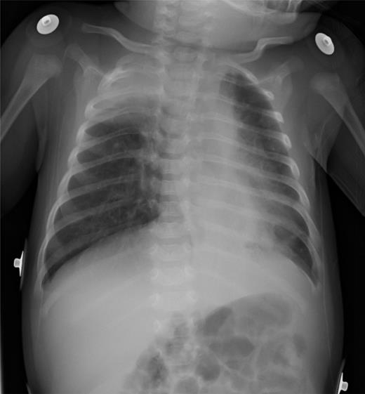 Respiratory Syncytial Virus Infection and Bronchiolitis | Pediatrics In ...