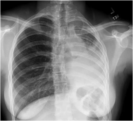 case study on pneumonia Figure 1. Chest radiograph on hospital admission.