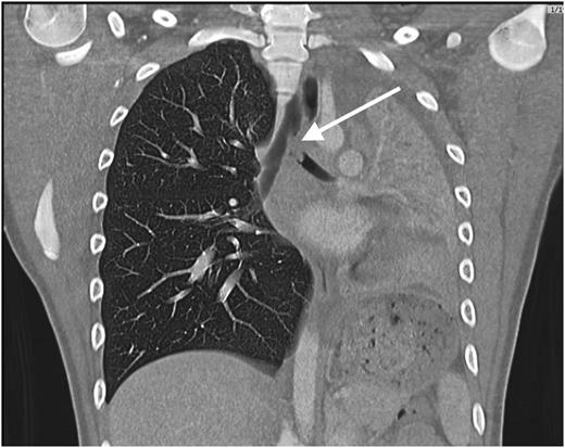 Figure 2. Computed tomographic scan of the chest revealing a filling defect in the left mainstem bronchus, collapse of the left lung, and compensatory hyperinflation of the right lung.