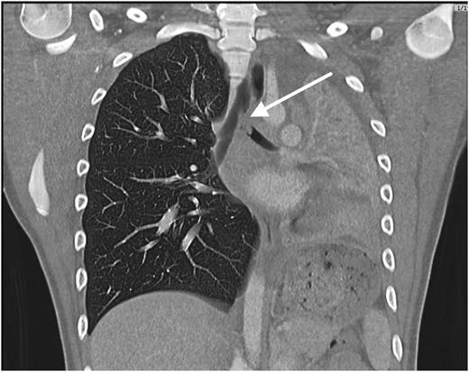 case study on pneumonia Figure 2. Computed tomographic scan of the chest revealing a filling defect in the left mainstem bronchus, collapse of the left lung, and compensatory hyperinflation of the right lung.