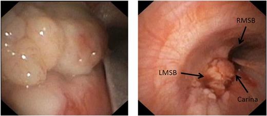 Figure 3. Bronchoscopic appearance of the tumor obstructing the takeoff of the left mainstem bronchus (LMSB), the open right mainstem bronchus (RMSB), and the carina.