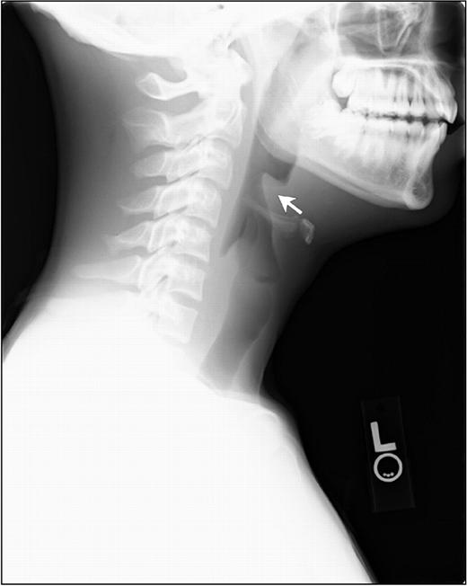 Lateral neck x-ray: epiglottitis. Arrow points to swollen epiglottis, the “thumbprint sign.” (Courtesy of Pediatr Rev)