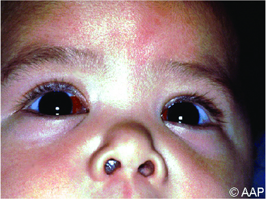 Subconjunctival hemorrhages from coughing. (Courtesy of AAP Red Book)