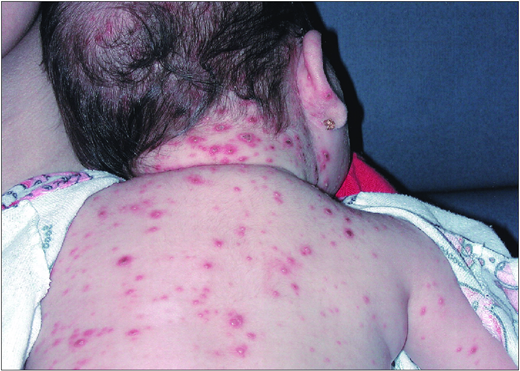 Typical varicella vesicles. (Courtesy of Pediatr Rev)