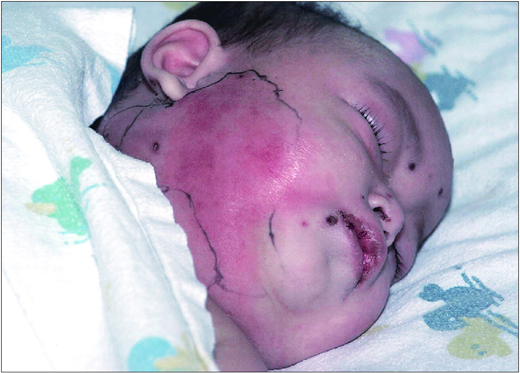 Secondary infection in patient who has varicella. (Courtesy of Pediatr Rev)