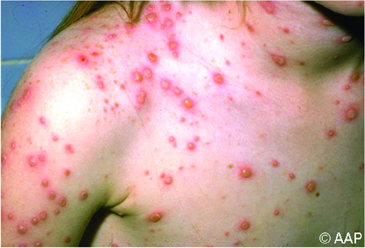 Varicella lesions in various stages. (Courtesy of AAP Red Book)