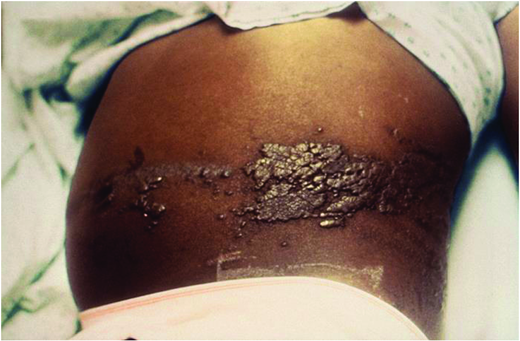 Zoster (shingles): vesicles in dermatomal distribution in child with leukemia. (Courtesy of CDC)