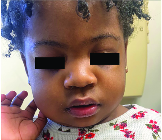 Mumps parotitis. (Courtesy of Pediatr Rev)
