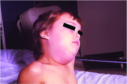Mumps parotitis and submandibular gland involvement. (Courtesy of CDC)