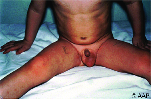 Mumps orchitis. (Courtesy of AAP Red Book)