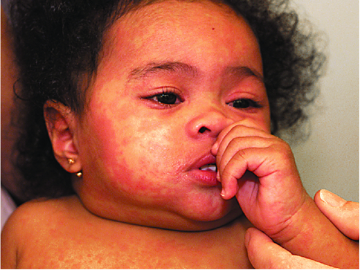 Measles rash. (Courtesy of Pediatr Rev)