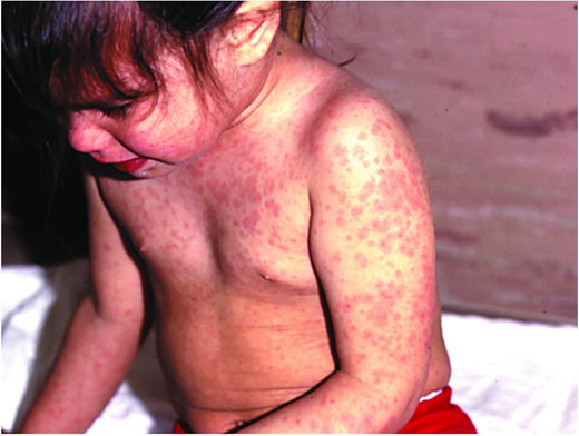 Measles rash. (Courtesy of Pediatr Rev)