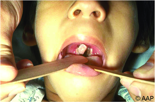 Pharyngeal pseudomembrane. (Courtesy of AAP Red Book)
